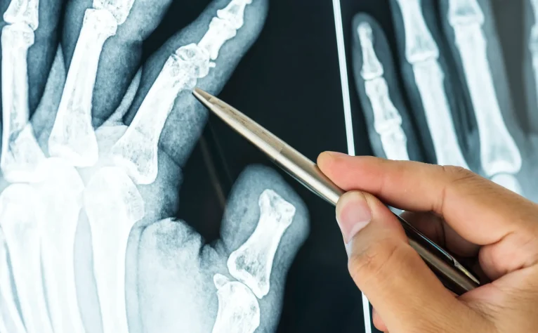 closeup-of-x-ray-filmof-a-fractured-finger
