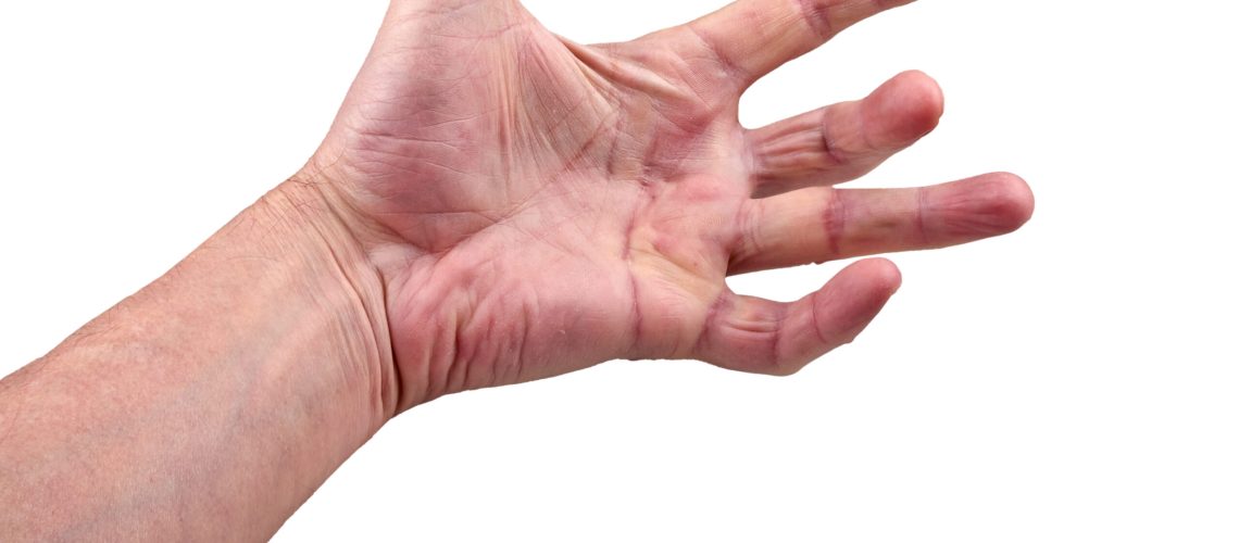 contratura de Dupuytren